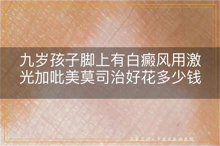 九岁孩子脚上有白癜风用激光加吡美莫司治好花多少钱