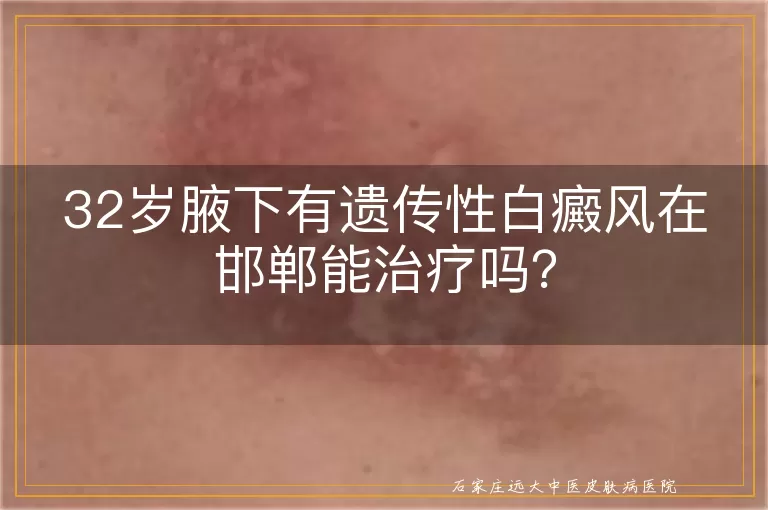 32岁腋下有遗传性白癜风在邯郸能治疗吗？