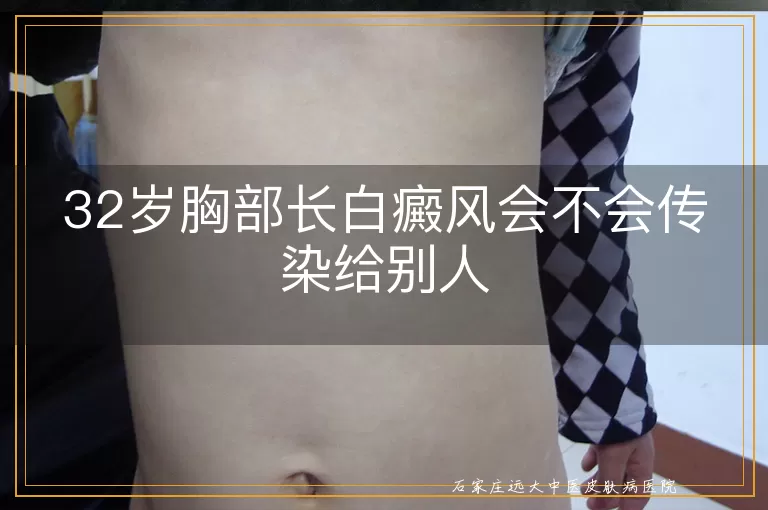 32岁胸部长白癜风会不会传染给别人