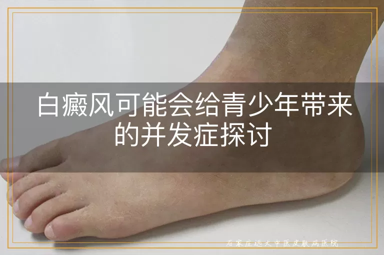 白癜风可能会给青少年带来的并发症探讨
