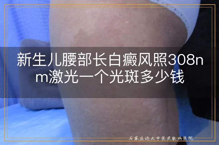 新生儿腰部长白癜风照308nm激光一个光斑多少钱