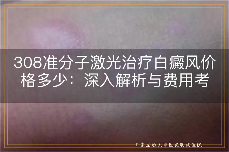 308准分子激光治疗白癜风价格多少：深入解析与费用考量