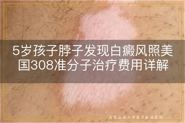 5岁孩子脖子发现白癜风照美国308准分子治疗费用详解