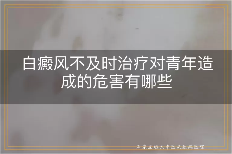 白癜风不及时治疗对青年造成的危害有哪些
