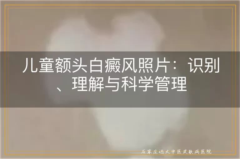 儿童额头白癜风照片：识别、理解与科学管理