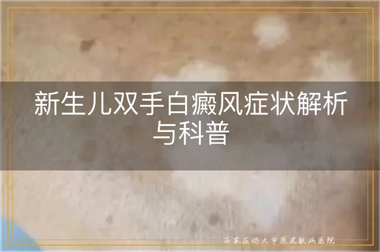 新生儿双手白癜风症状解析与科普