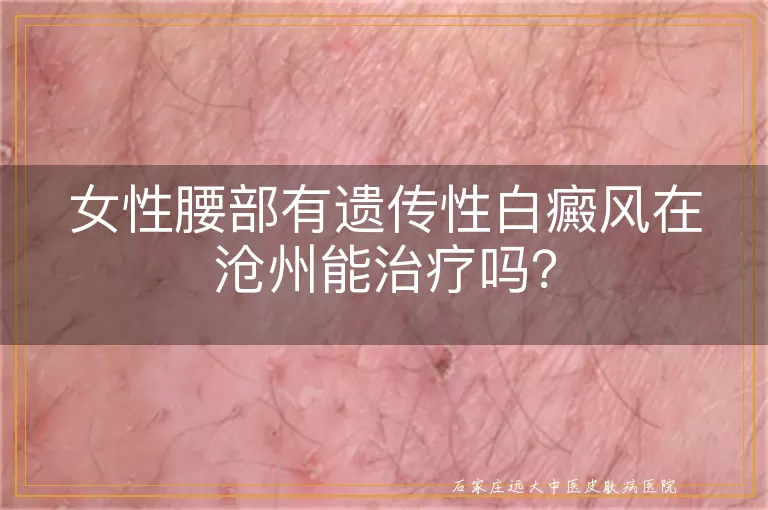 女性腰部有遗传性白癜风在沧州能治疗吗？