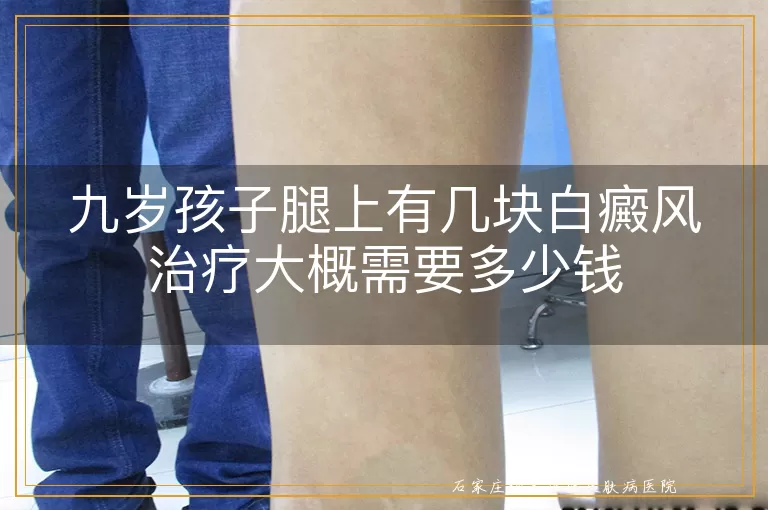 九岁孩子腿上有几块白癜风治疗大概需要多少钱