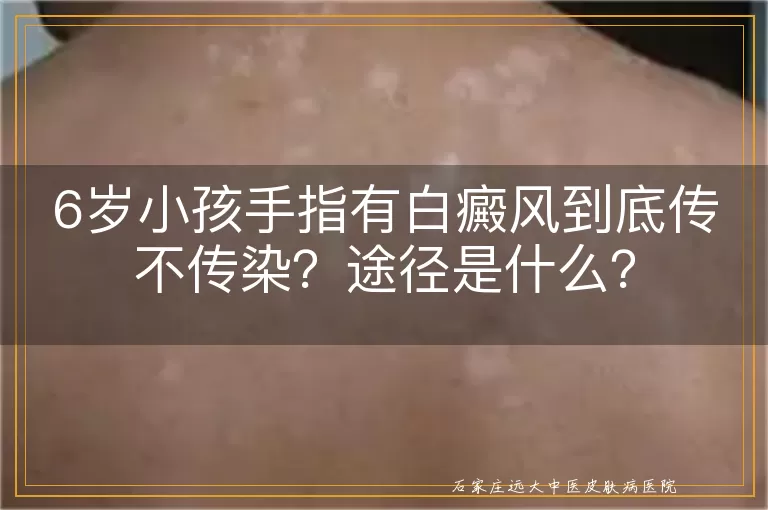 6岁小孩手指有白癜风到底传不传染？途径是什么？