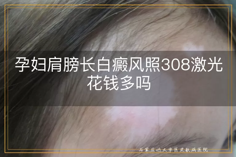 孕妇肩膀长白癜风照308激光花钱多吗