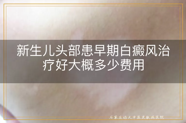 新生儿头部患早期白癜风治疗好大概多少费用