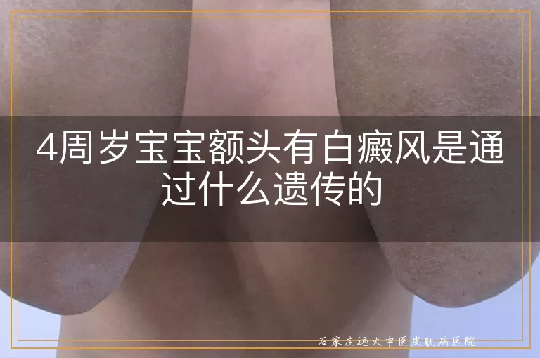 4周岁宝宝额头有白癜风是通过什么遗传的