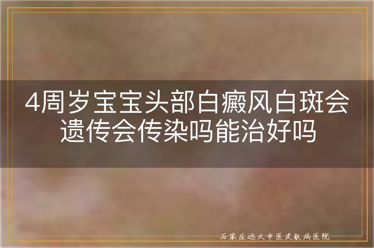 4周岁宝宝头部白癜风白斑会遗传会传染吗能治好吗
