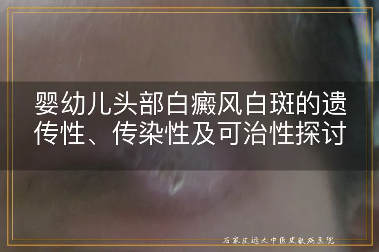婴幼儿头部白癜风白斑的遗传性、传染性及可治性探讨