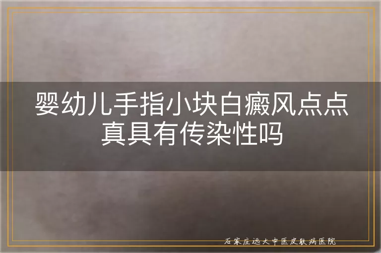 婴幼儿手指小块白癜风点点真具有传染性吗