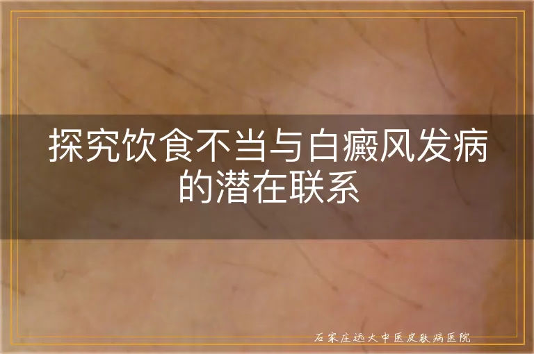 探究饮食不当与白癜风发病的潜在联系