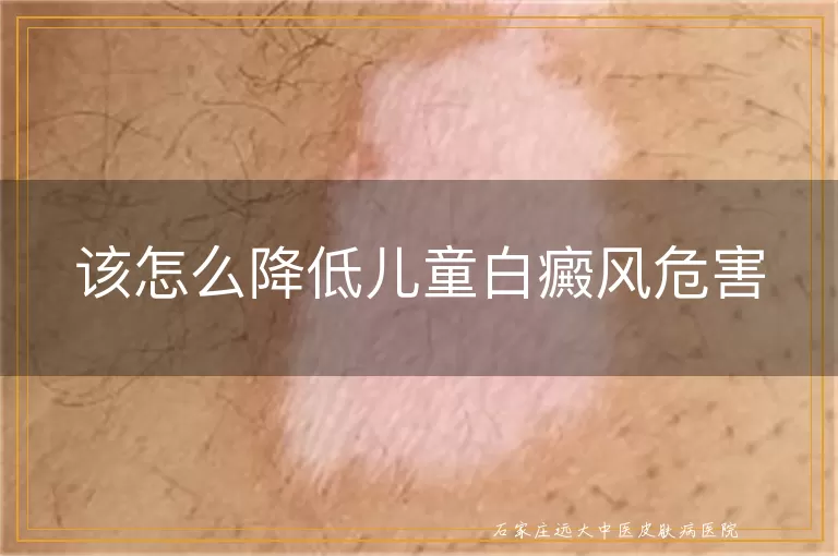 该怎么降低儿童白癜风危害