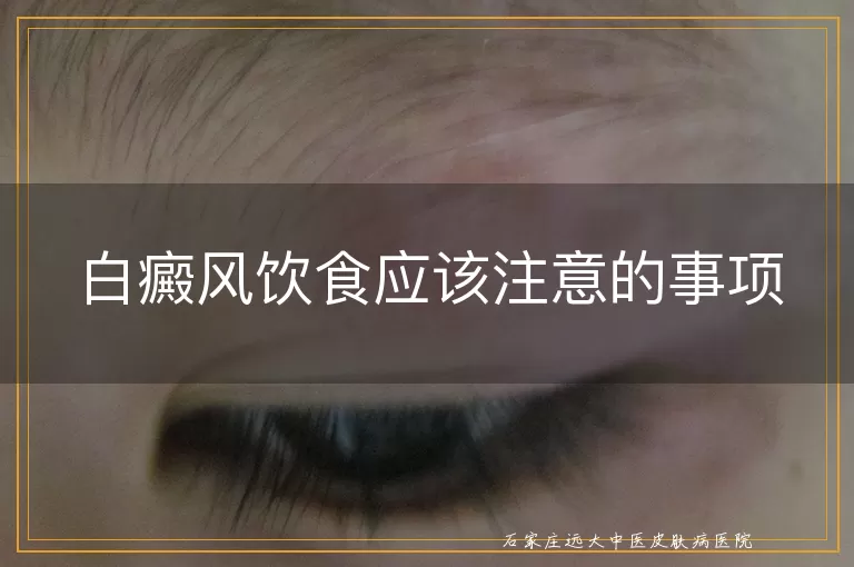 白癜风饮食应该注意的事项