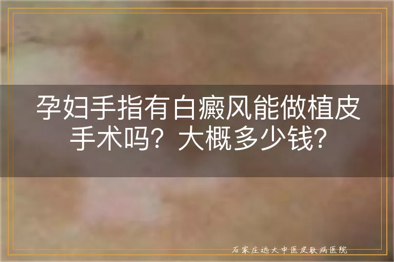 孕妇手指有白癜风能做植皮手术吗？大概多少钱？