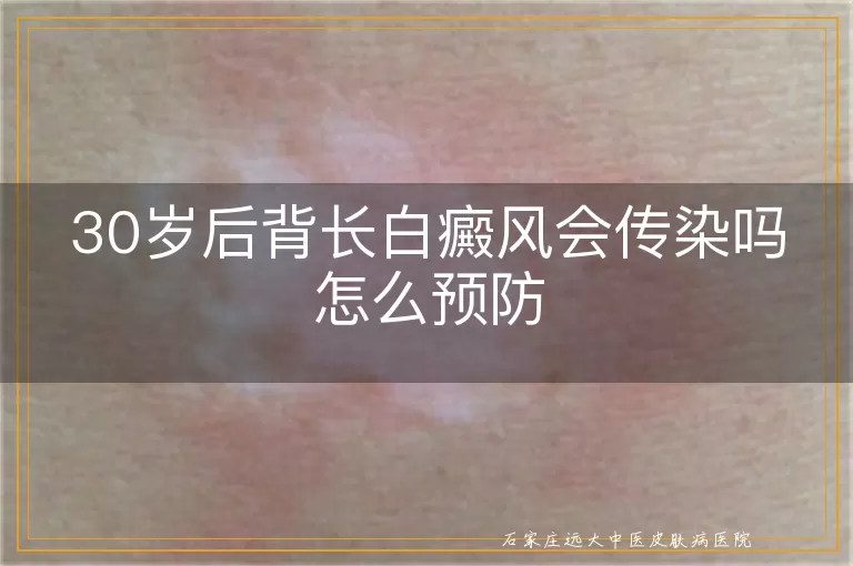 30岁后背长白癜风会传染吗怎么预防