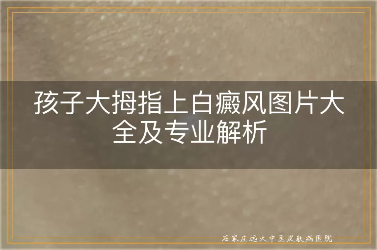 孩子大拇指上白癜风图片大全及专业解析