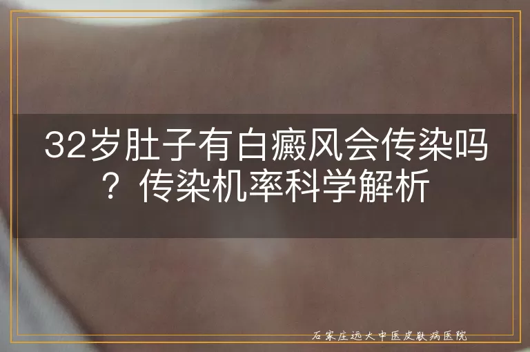 32岁肚子有白癜风会传染吗？传染机率科学解析