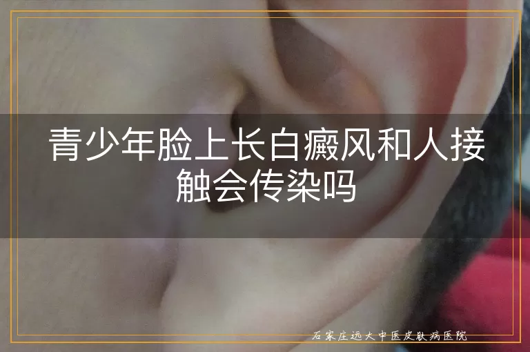 青少年脸上长白癜风和人接触会传染吗