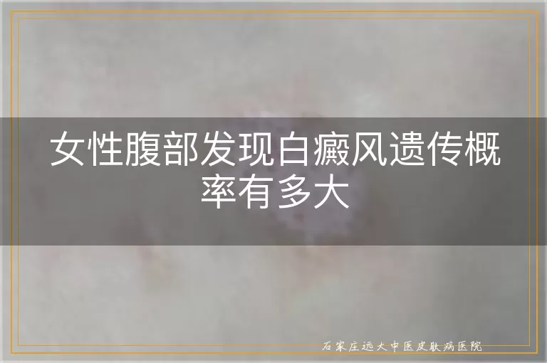 女性腹部发现白癜风遗传概率有多大