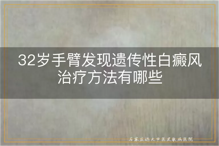 32岁手臂发现遗传性白癜风治疗方法有哪些
