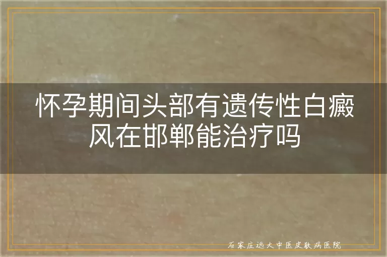 怀孕期间头部有遗传性白癜风在邯郸能治疗吗
