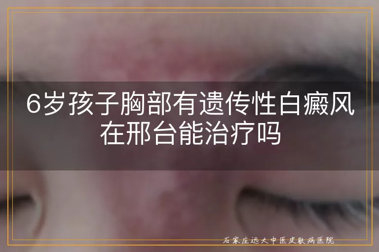 6岁孩子胸部有遗传性白癜风在邢台能治疗吗