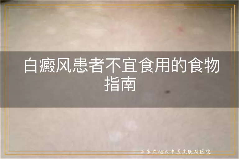 白癜风患者不宜食用的食物指南