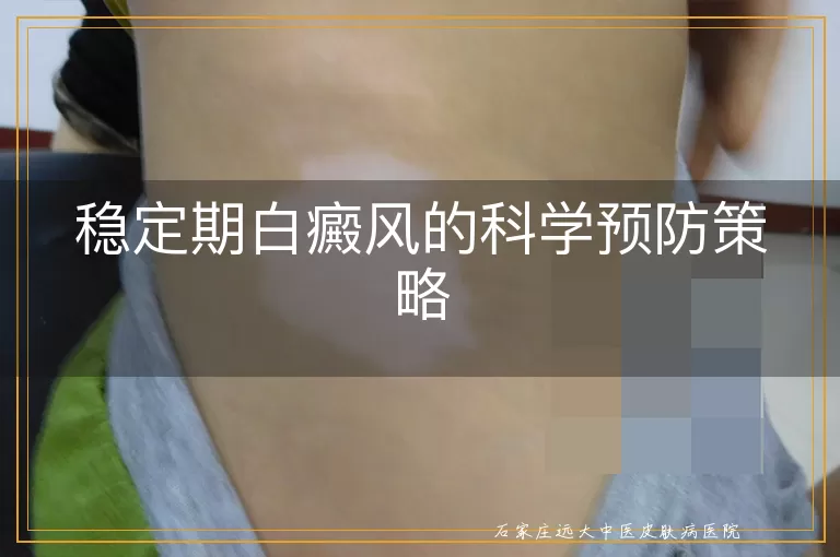 稳定期白癜风的科学预防策略