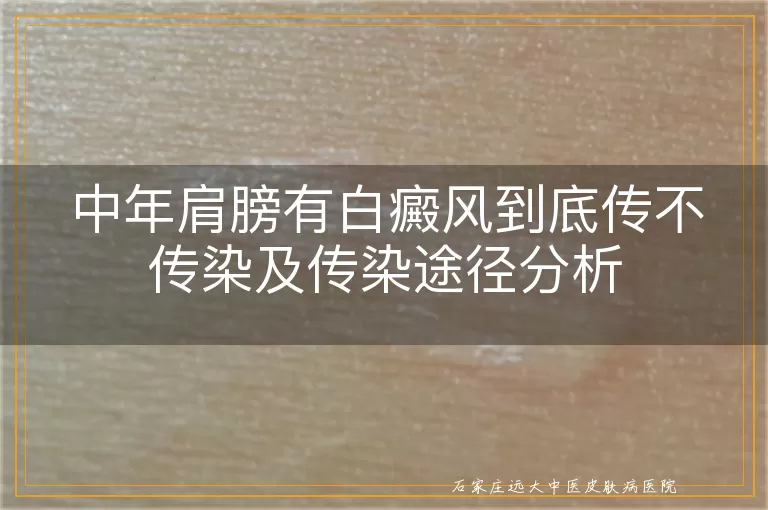 中年肩膀有白癜风到底传不传染及传染途径分析