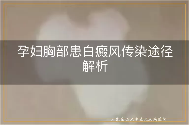孕妇胸部患白癜风传染途径解析
