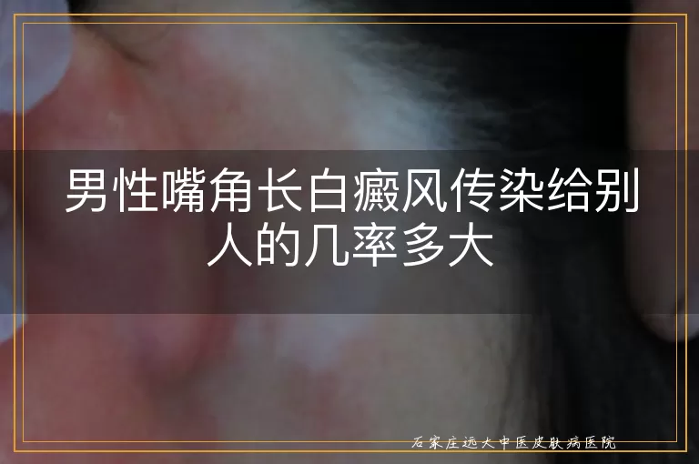男性嘴角长白癜风传染给别人的几率多大