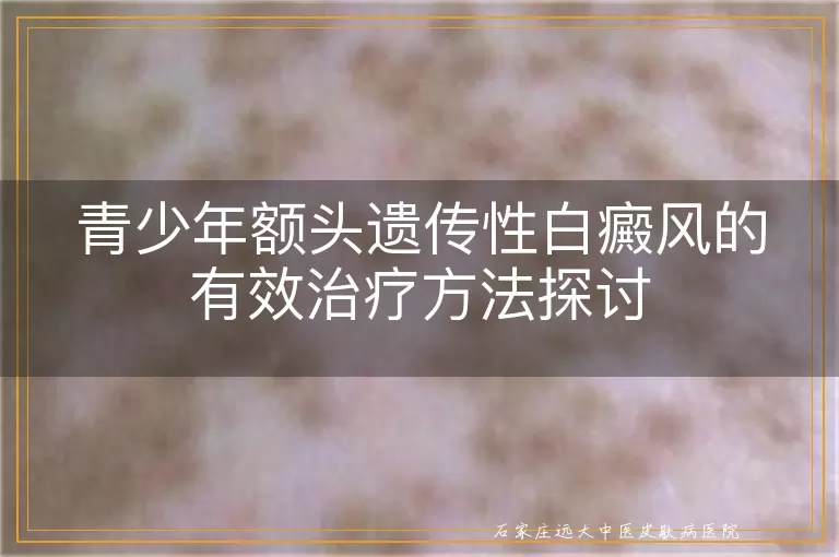 青少年额头遗传性白癜风的有效治疗方法探讨