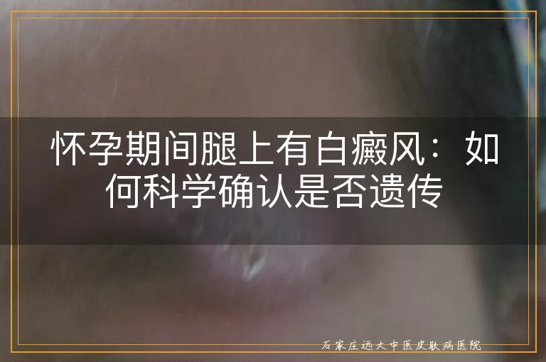 怀孕期间腿上有白癜风：如何科学确认是否遗传
