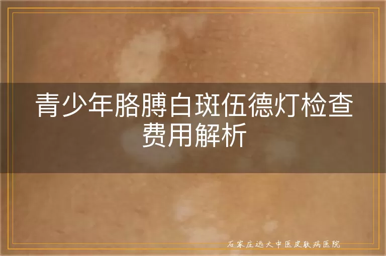 青少年胳膊白斑伍德灯检查费用解析