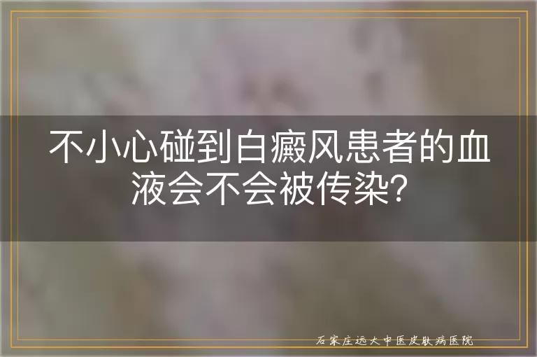 不小心碰到白癜风患者的血液会不会被传染？