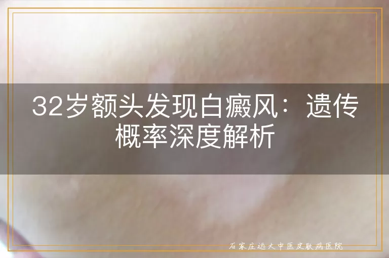 32岁额头发现白癜风：遗传概率深度解析