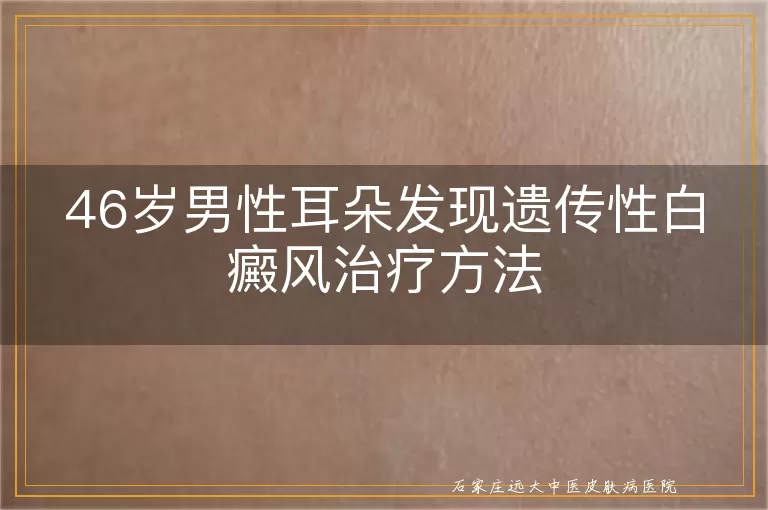 46岁男性耳朵发现遗传性白癜风治疗方法