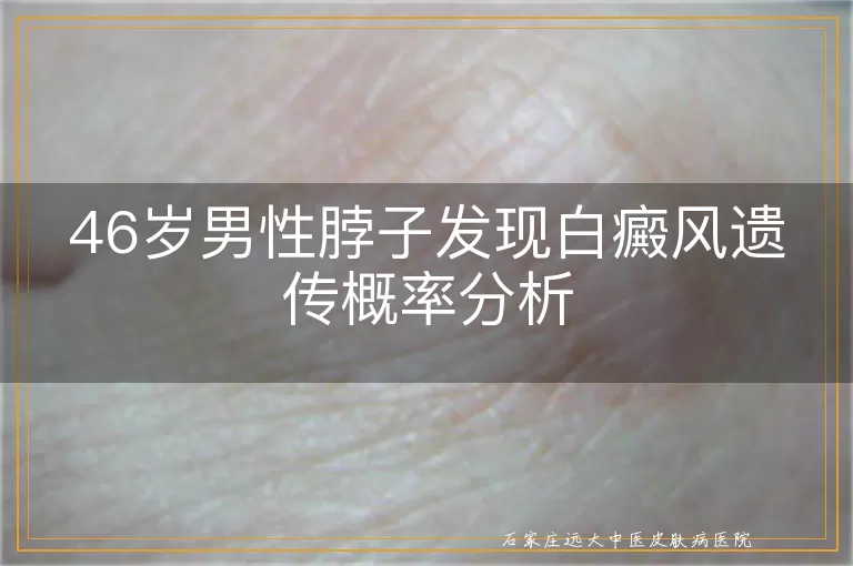 46岁男性脖子发现白癜风遗传概率分析