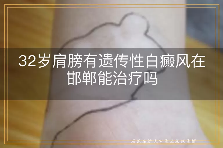 32岁肩膀有遗传性白癜风在邯郸能治疗吗