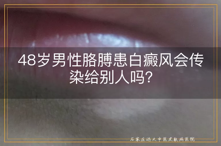 48岁男性胳膊患白癜风会传染给别人吗？