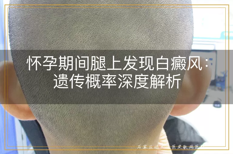 怀孕期间腿上发现白癜风：遗传概率深度解析