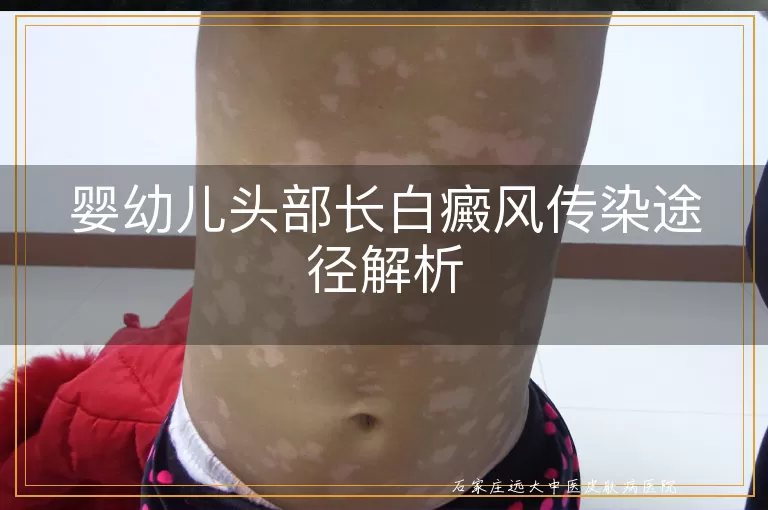 婴幼儿头部长白癜风传染途径解析
