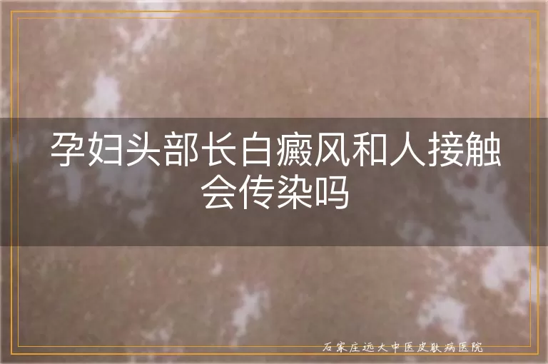 孕妇头部长白癜风和人接触会传染吗