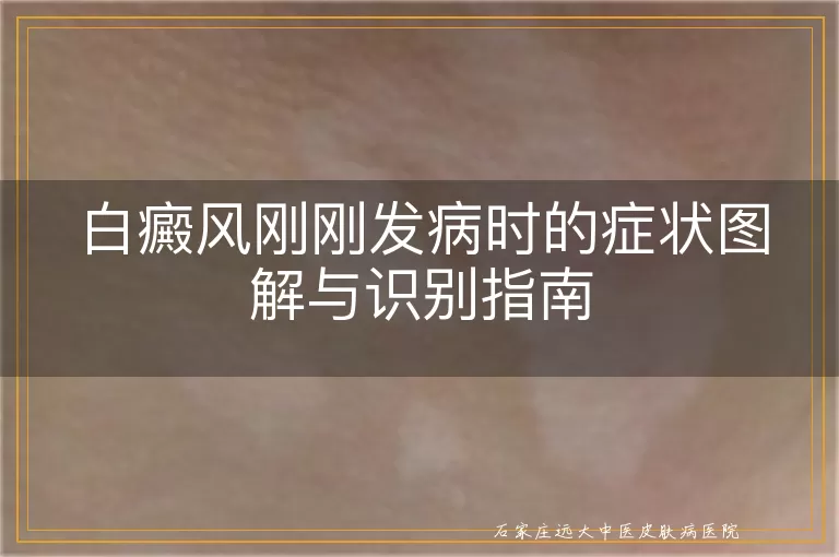 白癜风刚刚发病时的症状图解与识别指南