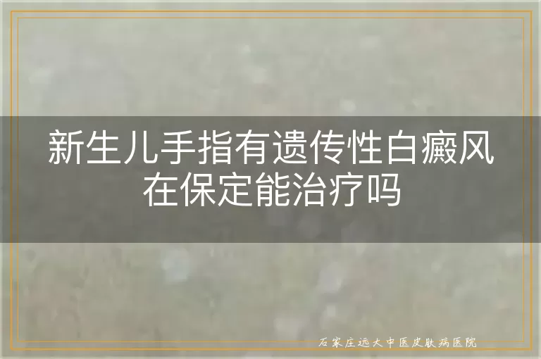 新生儿手指有遗传性白癜风在保定能治疗吗